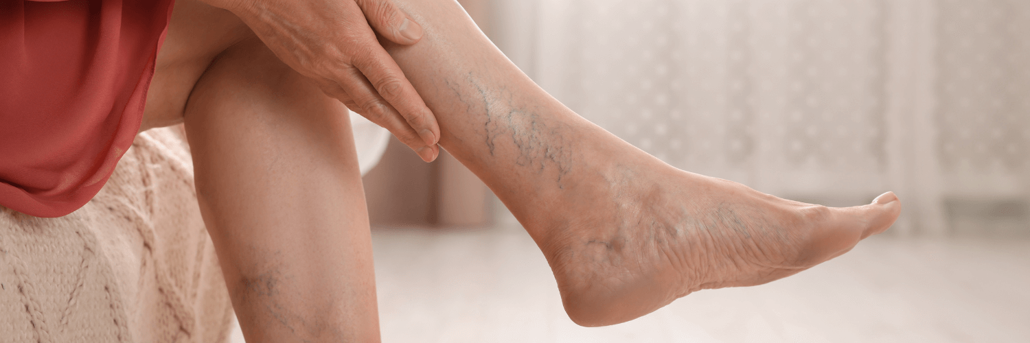 Descubre qué son las várices, cómo identificar las "arañitas" y cuándo buscar ayuda médica profesional en México.