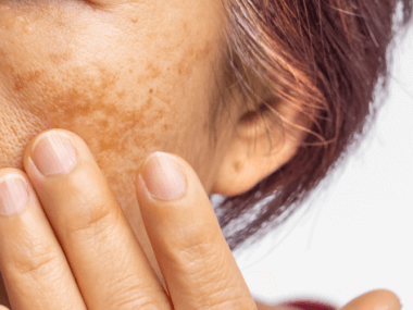¿Tienes manchas en el rostro? Descubre qué es el melasma, por qué aparece en el embarazo y cómo tratar el paño con consejos de expertos en México.