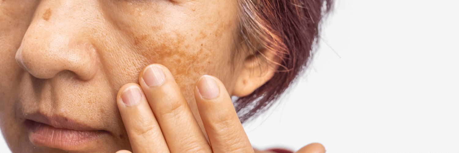 ¿Tienes manchas en el rostro? Descubre qué es el melasma, por qué aparece en el embarazo y cómo tratar el paño con consejos de expertos en México.
